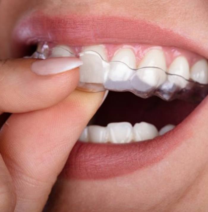 close up of someone putting Invisalign aligner in their mouth 