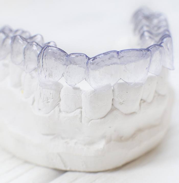 Clear aligner for Invisalign on a dental mold.