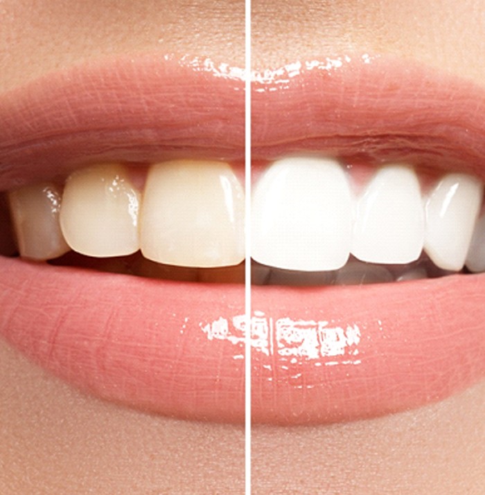 A before and after image of a person’s smile after undergoing at-home teeth whitening