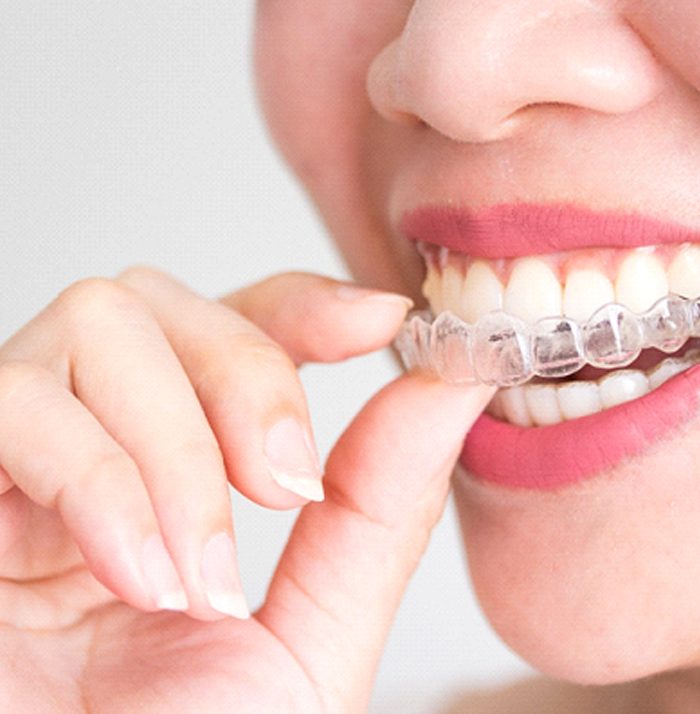 image of a woman inserting an Invisalign aligner to help correct her overbite in Kansas City