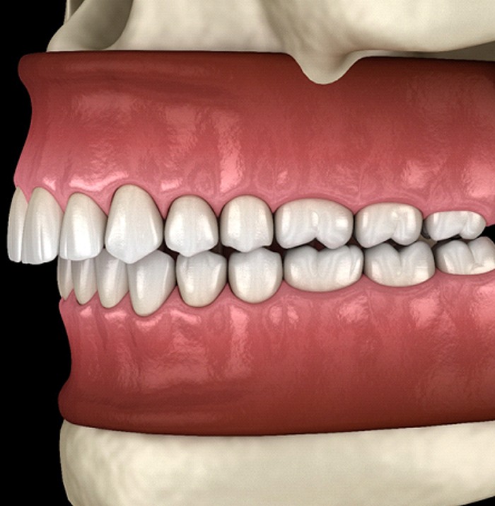 A digital image of an overbite with the upper teeth protruding out and over the bottom teeth