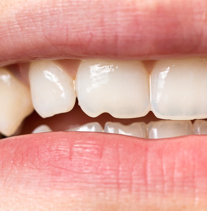 A closeup of a slightly chipped front tooth