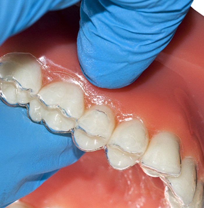 Clear aligner on dental mold.