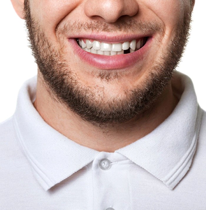 Man missing a tooth needing a dental bridge.