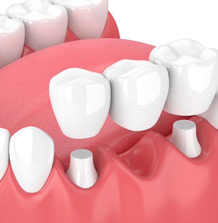 Model of a fixed dental bridge.