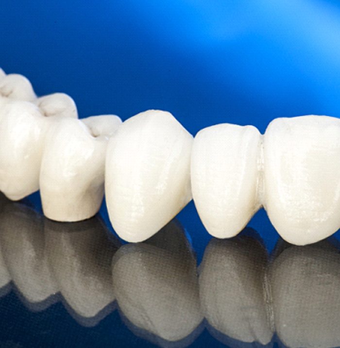 Model of a dental bridge and crowns.