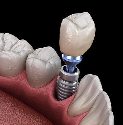 Dental implant in Kansas City