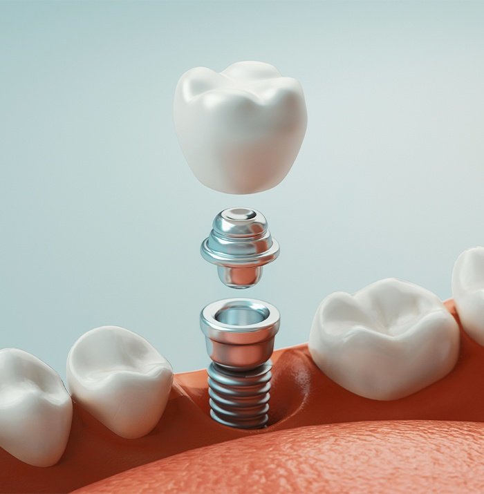 dental implant in Kansas City being placed in the lower jaw