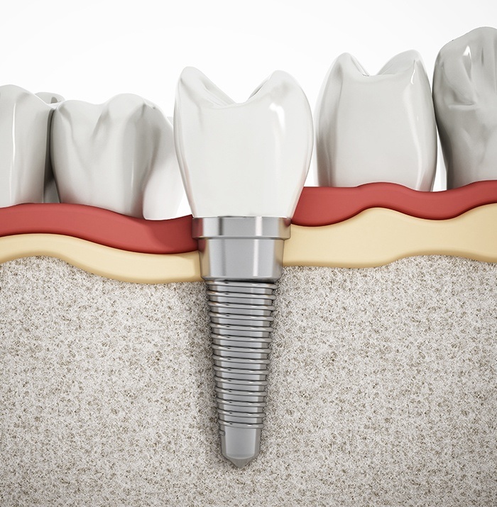 dental implant in the lower jawbone