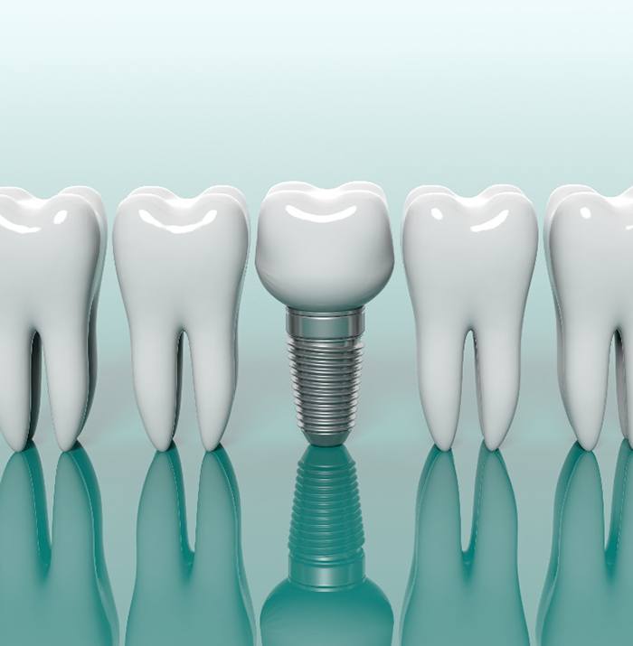 dental implant with crown between several natural teeth