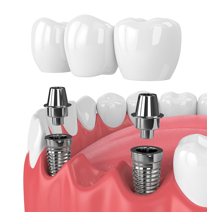 dental bridge supported by two dental implants