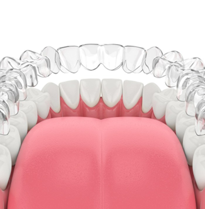 Illustration of Invisalign aligner being placed on teeth