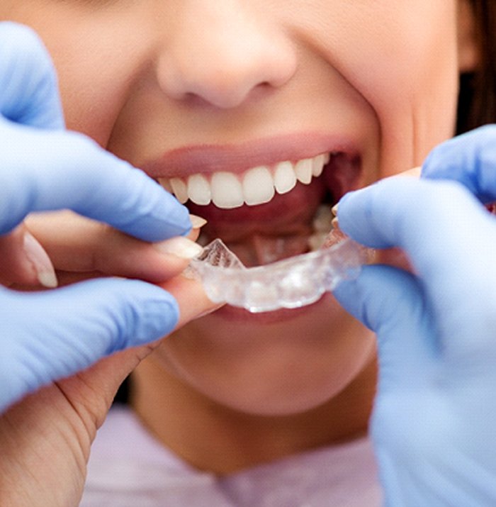 Dentist helping woman put in Invisalign aligner