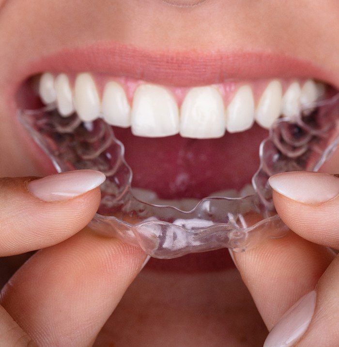 Woman holding a clear aligner. 