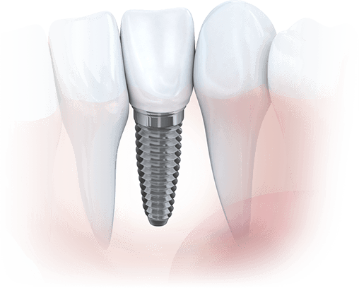 Graphic of dental implants