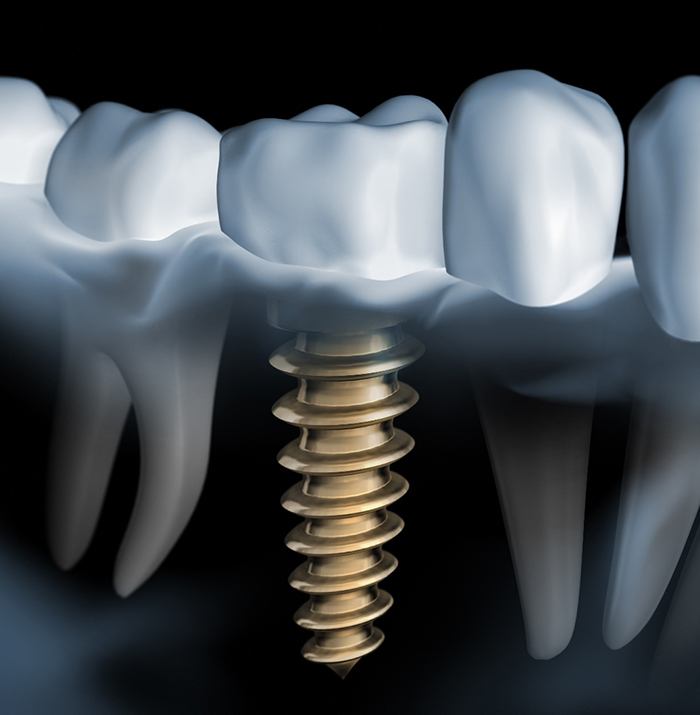 Image of a dental implant replacing a missing tooth.