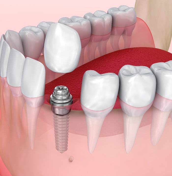 Model showing an abutment and a dental crown.