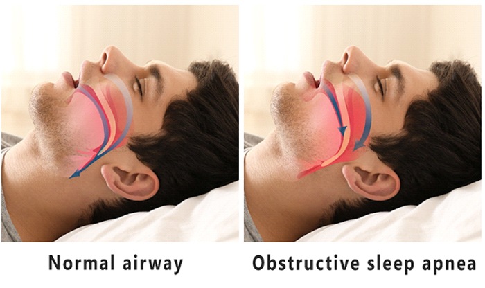 normal vs. obstructed airway
