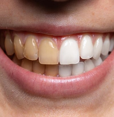 Before/after of a teeth whitening treatment