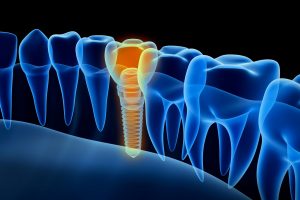 digital model dental implant
