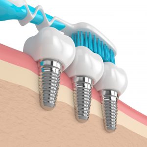 toothbrush and dental implants