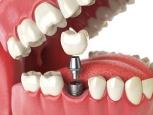 3D drawing of a mouth with a dental implant