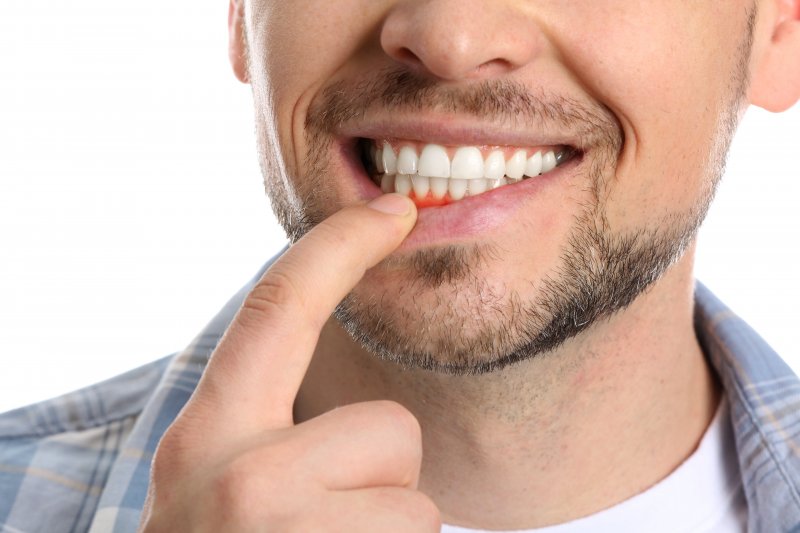 man with visibly red gums