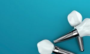 dental implants in Kansas City