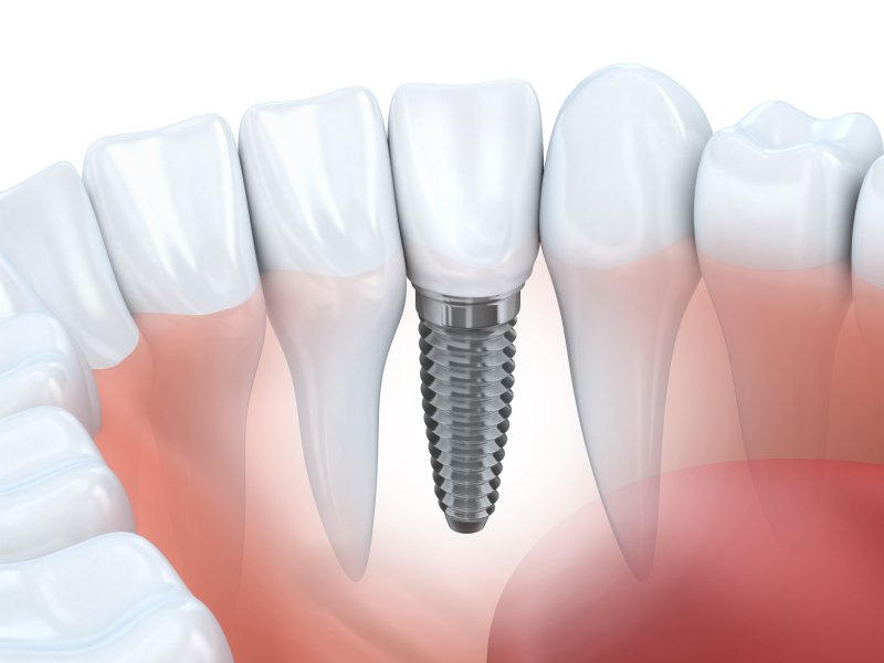 3-D diagram of a dental implant