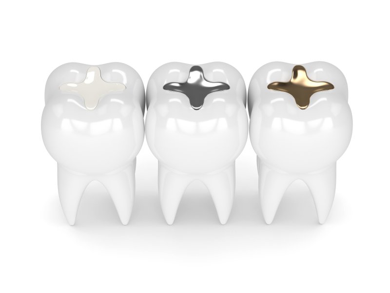 3-D model of dental fillings