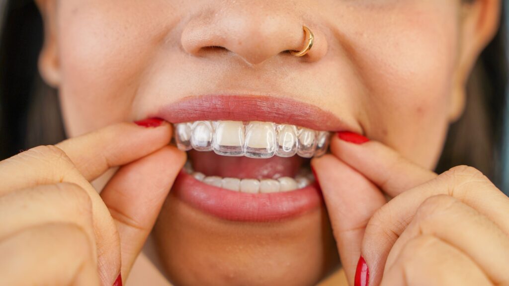 Closeup of woman removing Invisalign from upper arch